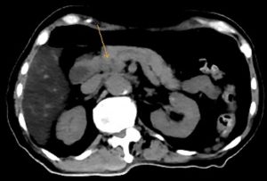 CT scan component of PET scan done after 2 months of erdafitinib treatment showing interval resolution of the previously seen neoplasm indicated by arrow in the pancreatic head. PET, positron emission tomography.